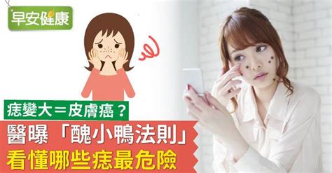 痣變大變凸|痣變大＝皮膚癌？醫曝「醜小鴨法則」看懂哪些痣最危險